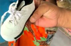 Orthopedic shoes or orthoses are needed for clubfoot treatment.